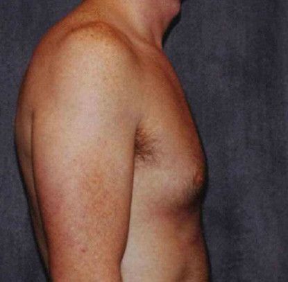 Gynecomastia Before & After