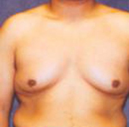 Gynecomastia Before & After