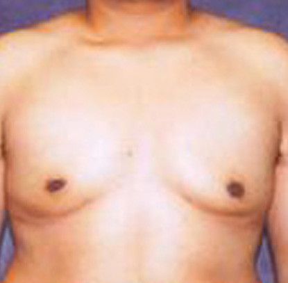 Gynecomastia Before & After