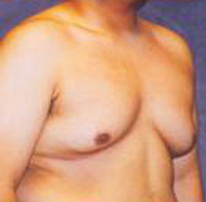 Gynecomastia Before & After