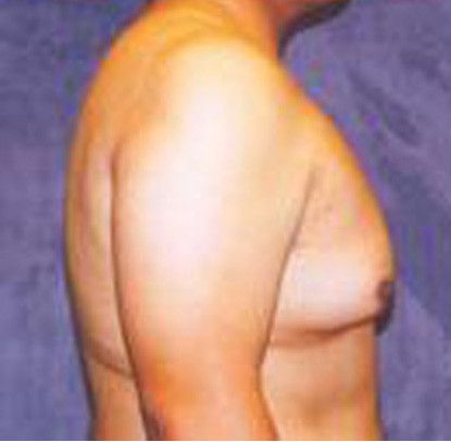 Gynecomastia Before & After