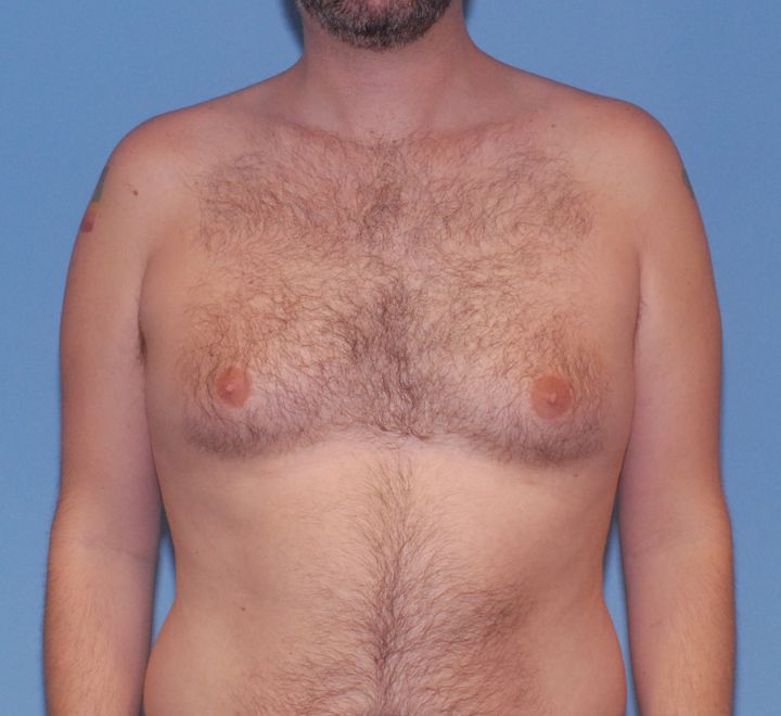 Gynecomastia Before & After