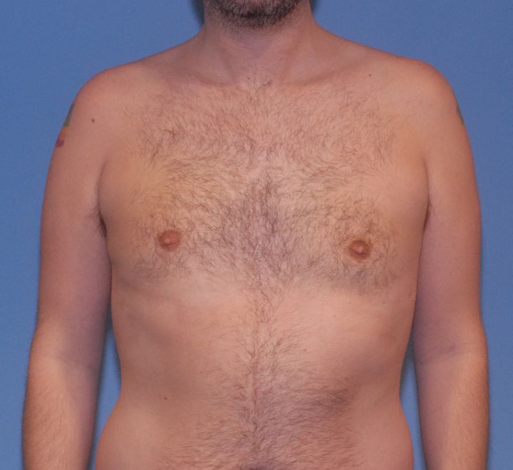 Gynecomastia Before & After