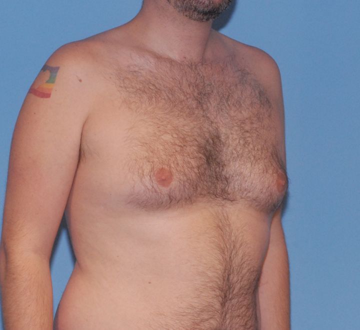 Gynecomastia Before & After