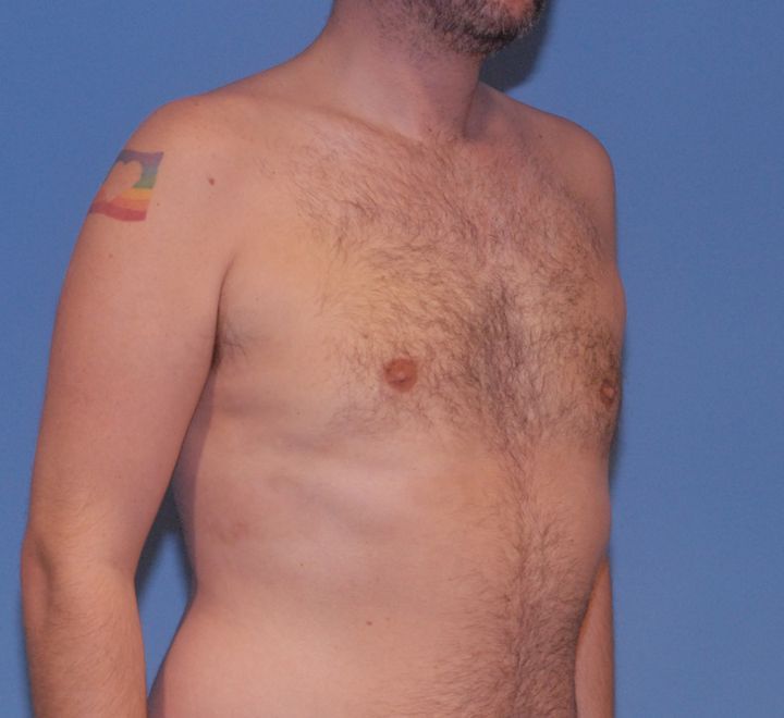 Gynecomastia Before & After