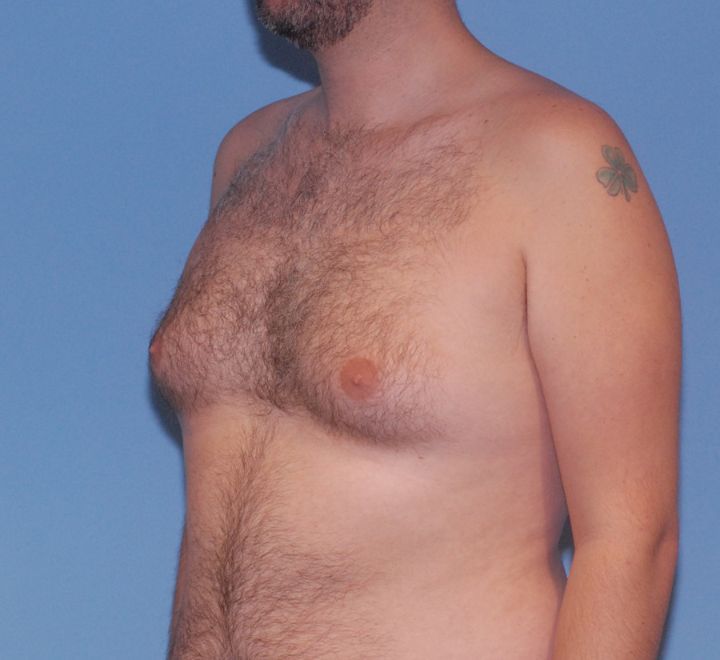 Gynecomastia Before & After