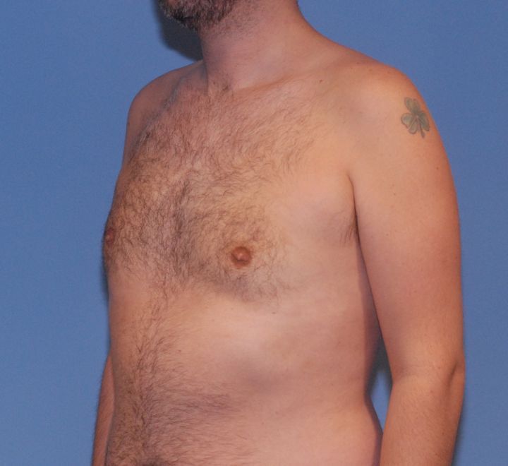 Gynecomastia Before & After