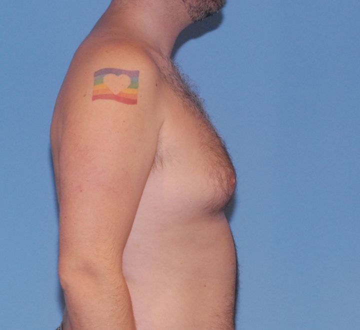 Gynecomastia Before & After