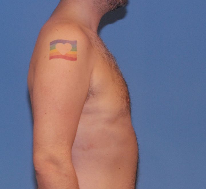 Gynecomastia Before & After