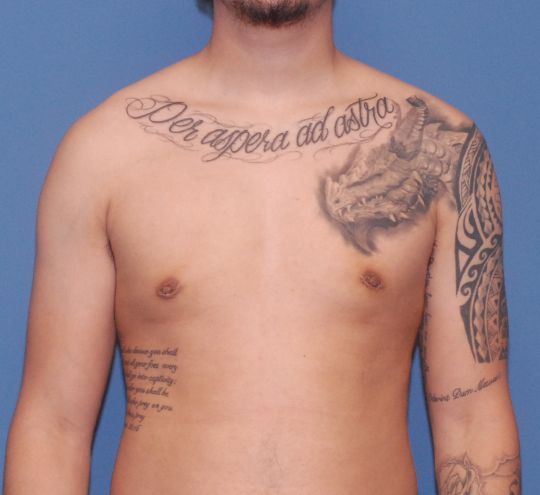 Gynecomastia Before & After