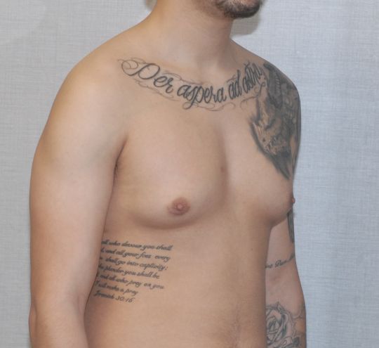 Gynecomastia Before & After
