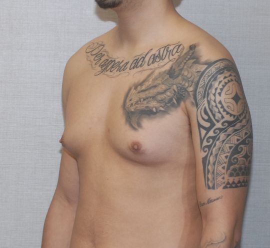 Gynecomastia Before & After