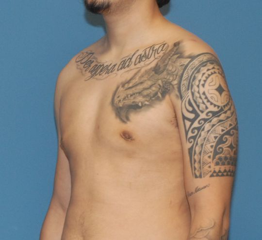 Gynecomastia Before & After