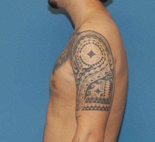 Gynecomastia Before & After