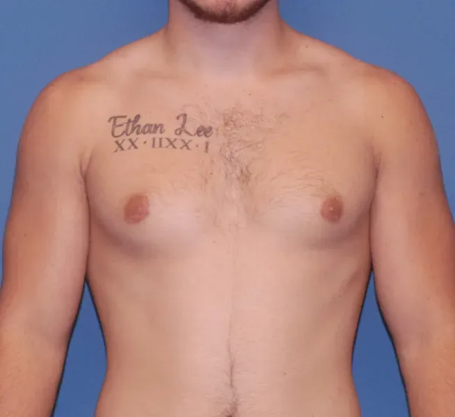 Gynecomastia Before & After