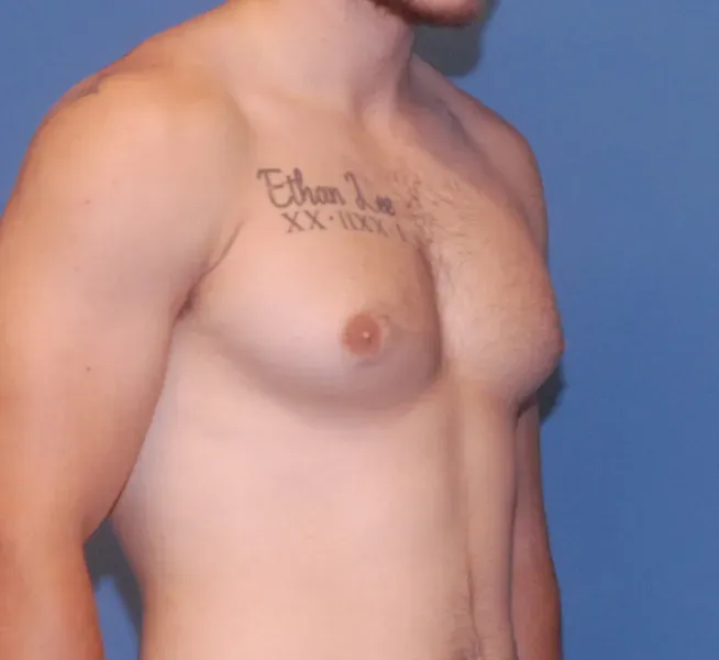 Gynecomastia Before & After