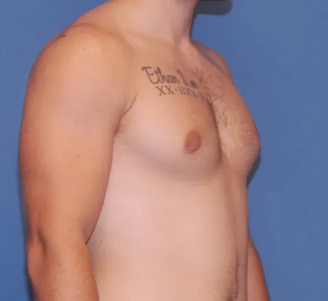 Gynecomastia Before & After