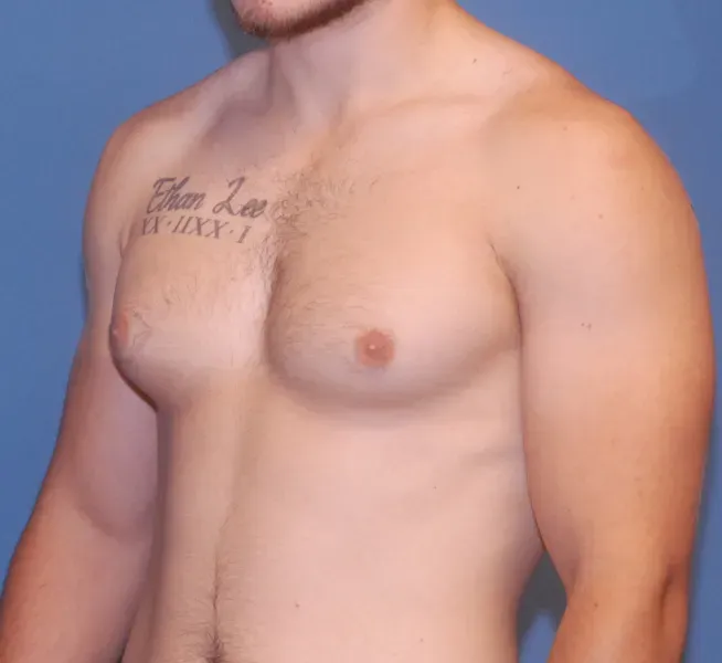 Gynecomastia Before & After