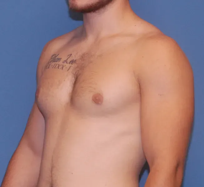 Gynecomastia Before & After