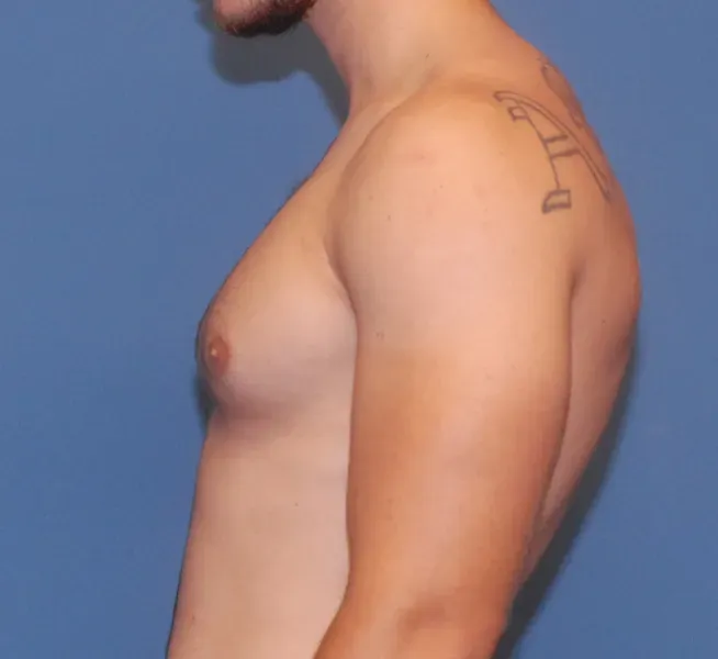 Gynecomastia Before & After