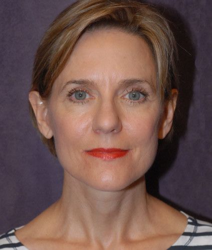 Neck Lift Before & After