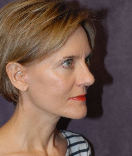 Neck Lift Before & After