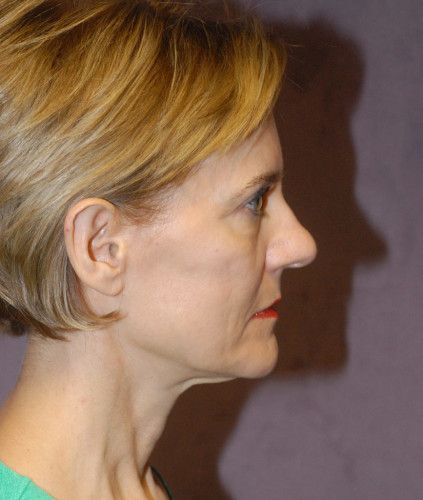 Neck Lift Before & After