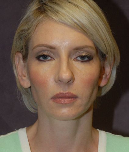 Neck Lift Before & After