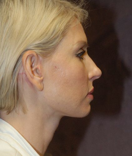 Neck Lift Before & After