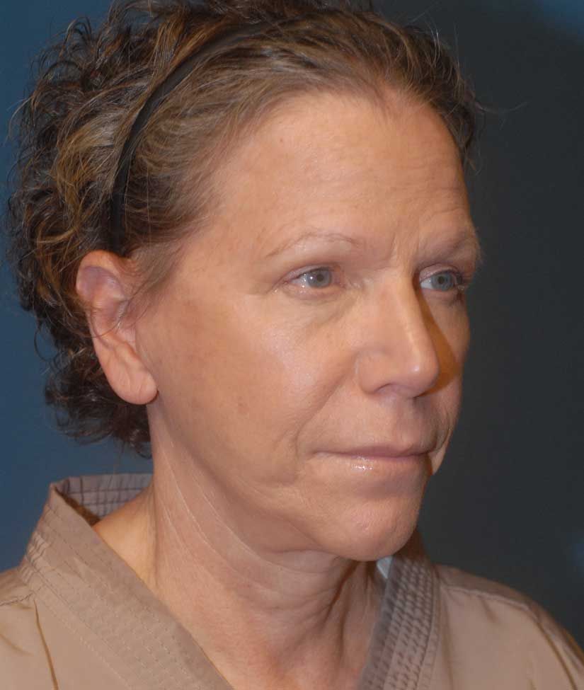 Neck Lift Before & After