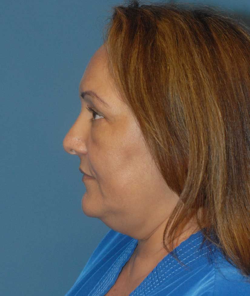 Neck Lift Before & After