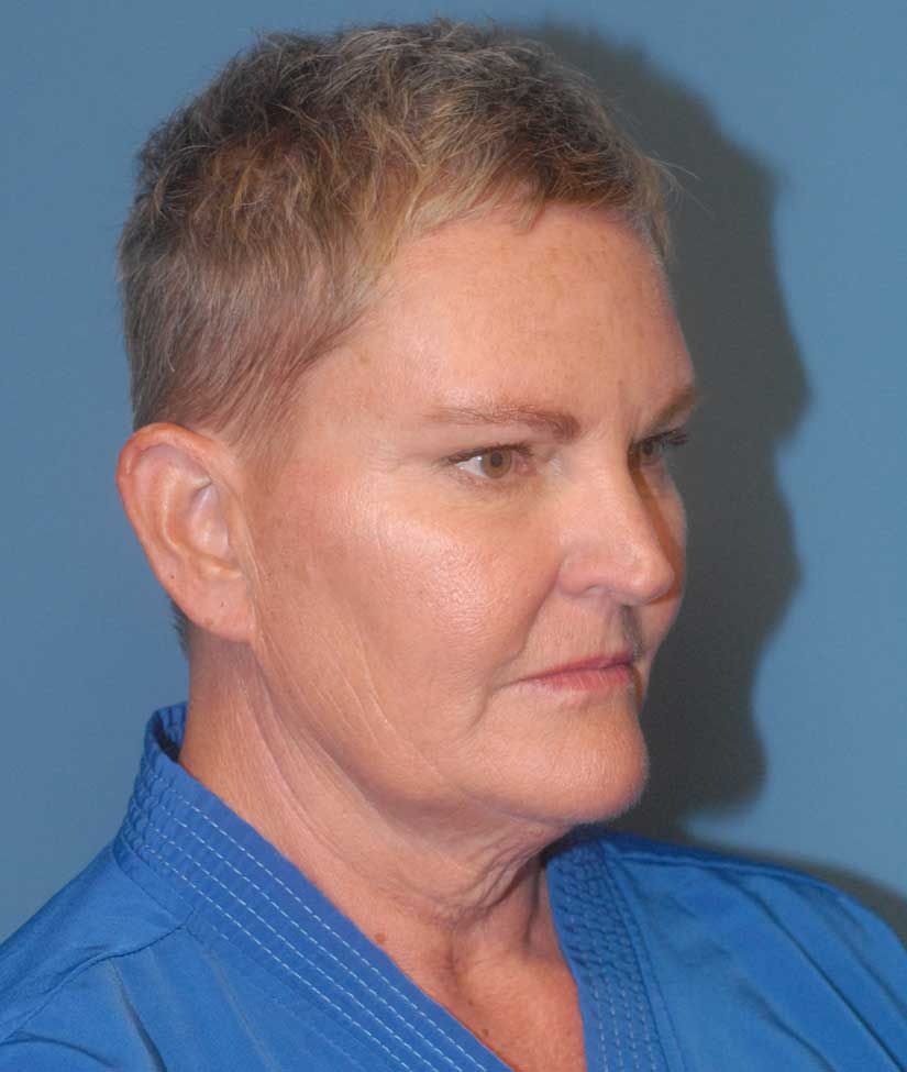 Neck Lift Before & After