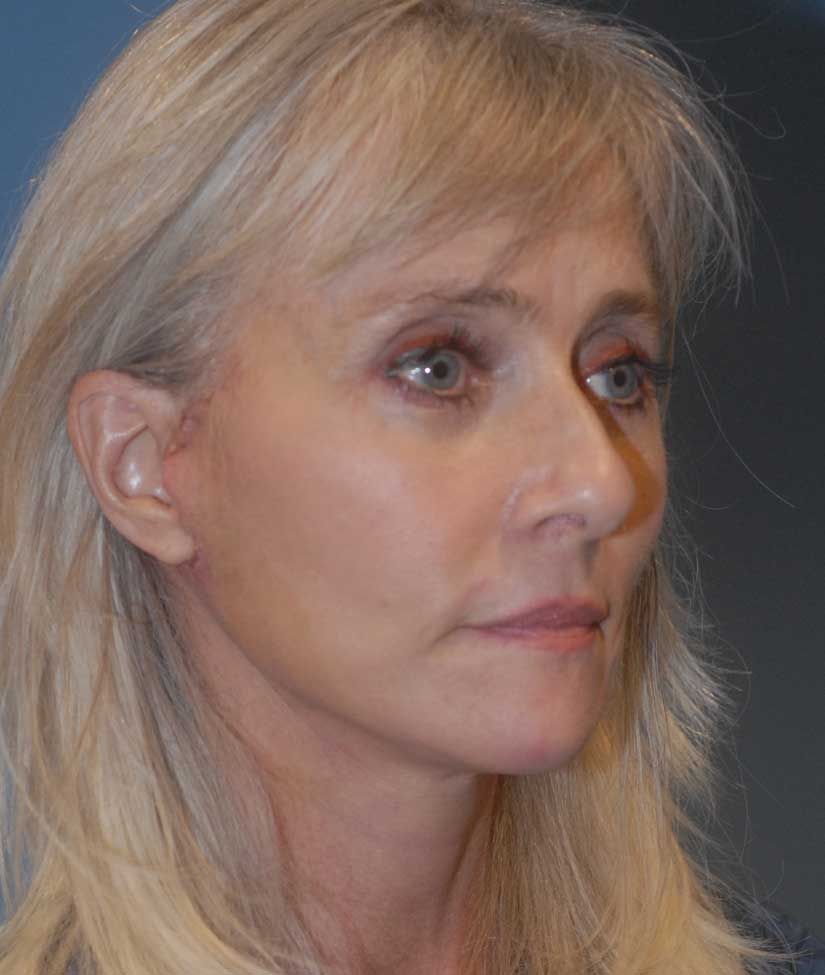 Neck Lift Before & After