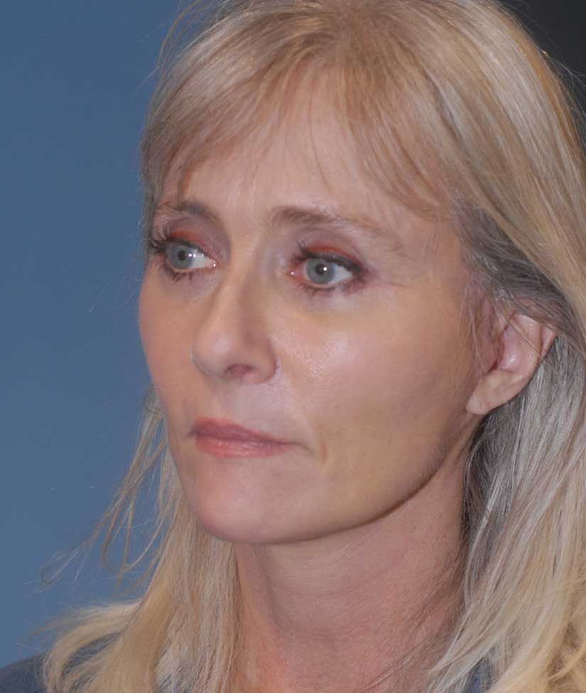 Neck Lift Before & After