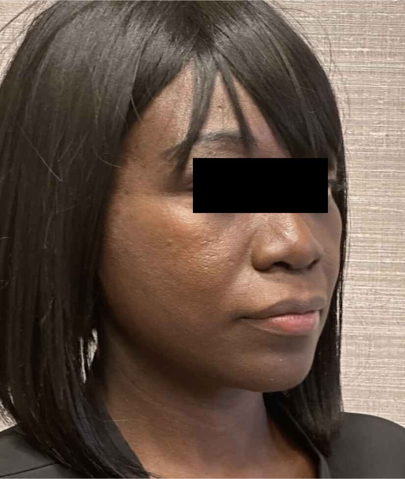 Neck Lift Before & After