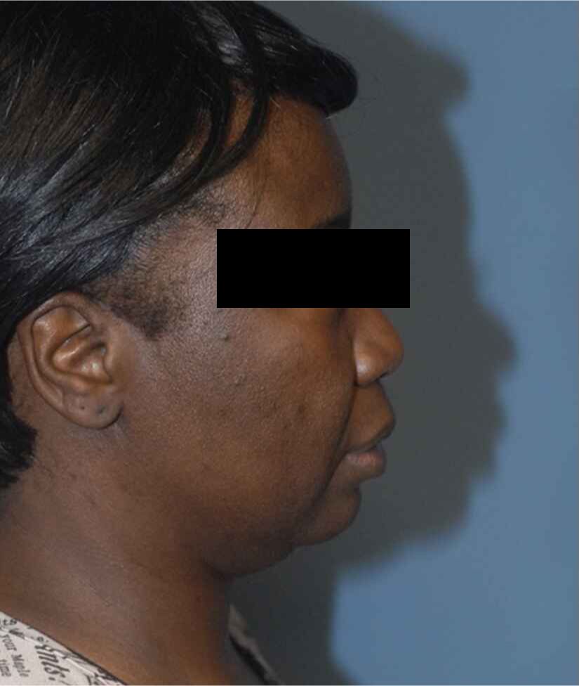 Neck Lift Before & After