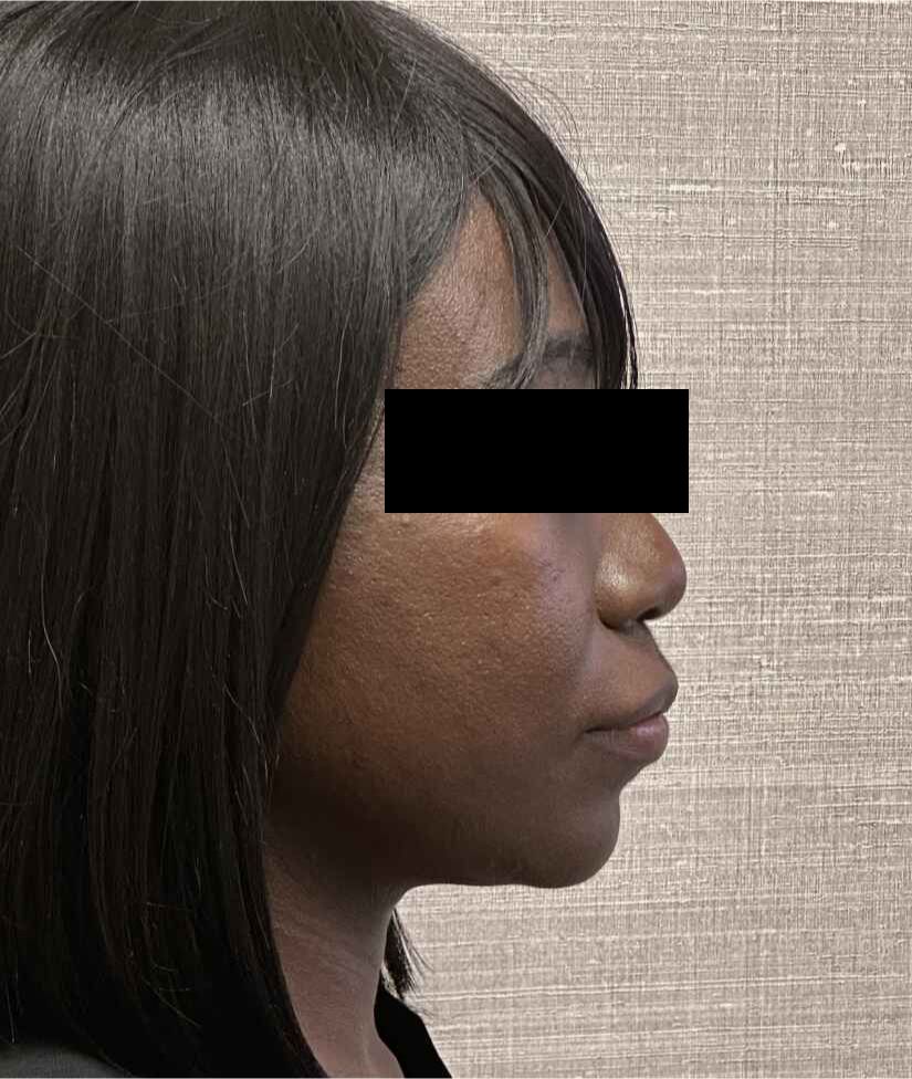 Neck Lift Before & After