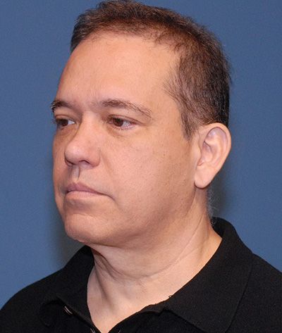 Neck Lift Before & After