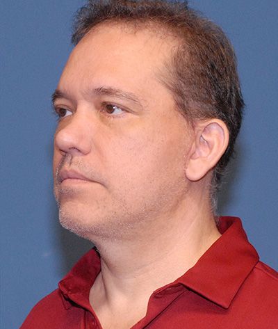 Neck Lift Before & After