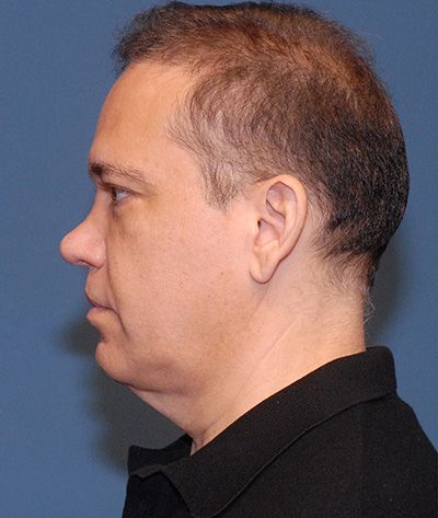 Neck Lift Before & After