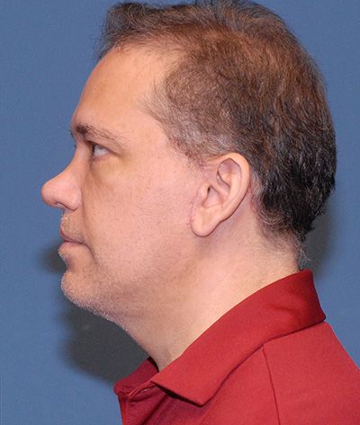 Neck Lift Before & After