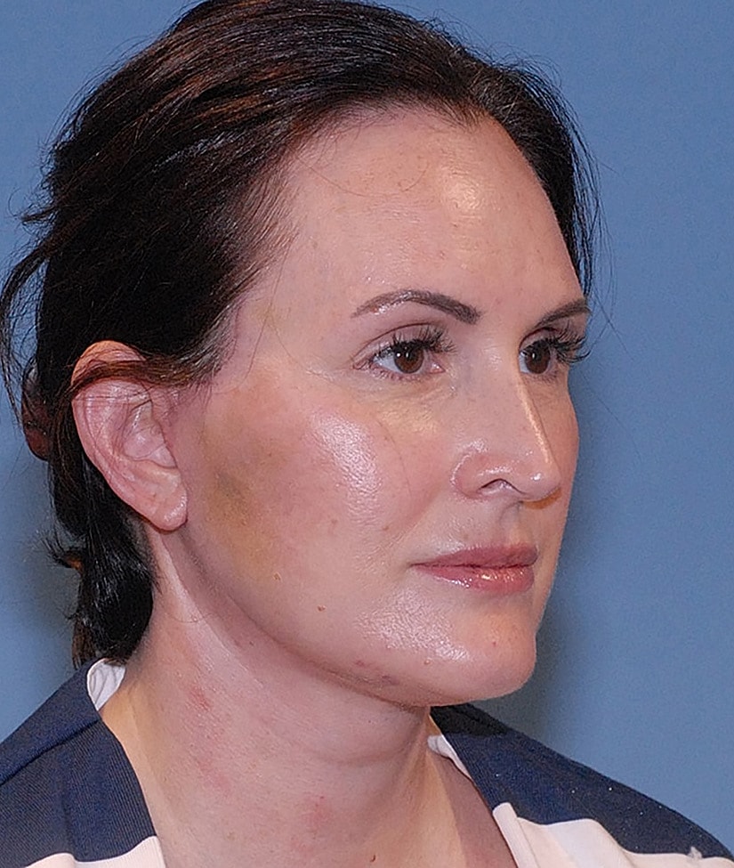 Neck Lift Before & After