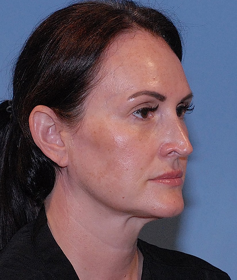 Neck Lift Before & After