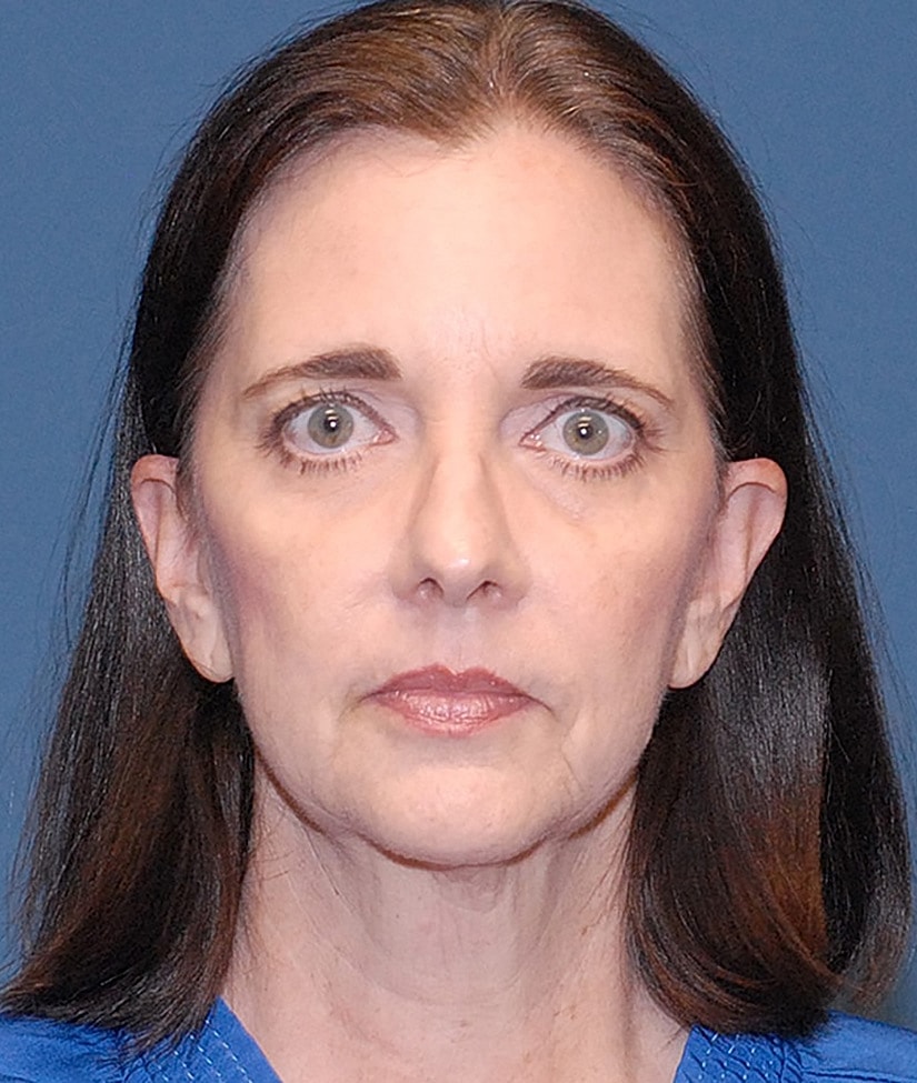 Neck Lift Before & After