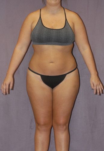 Brazilian Butt Lift Before & After