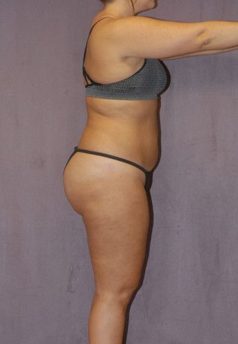 Brazilian Butt Lift Before & After