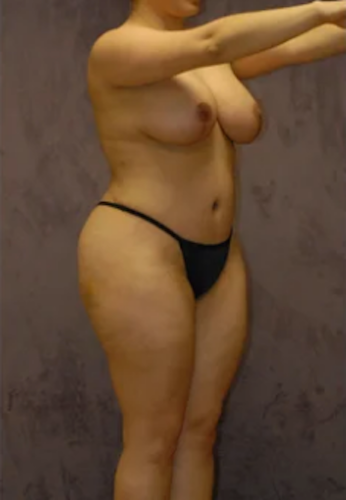 Brazilian Butt Lift Before & After