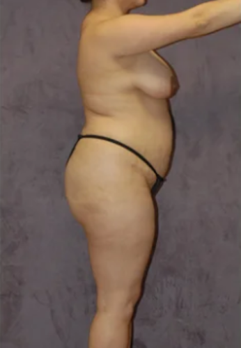 Brazilian Butt Lift Before & After