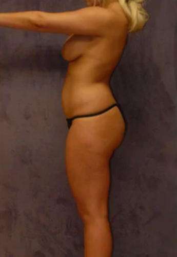 Brazilian Butt Lift Before & After