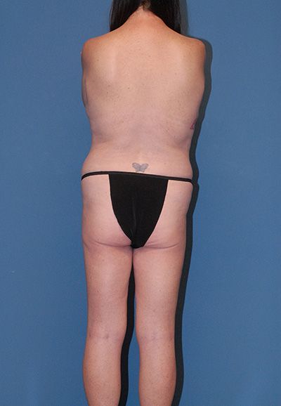 Brazilian Butt Lift Before & After